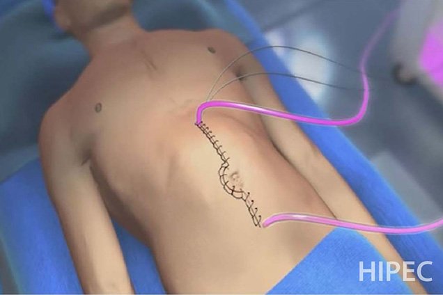 Risks or Complications of HIPEC Surgery